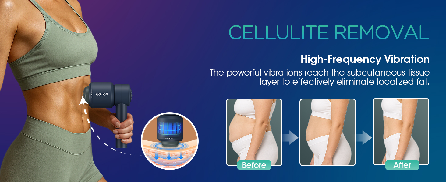 CELLULITE REMOVAL