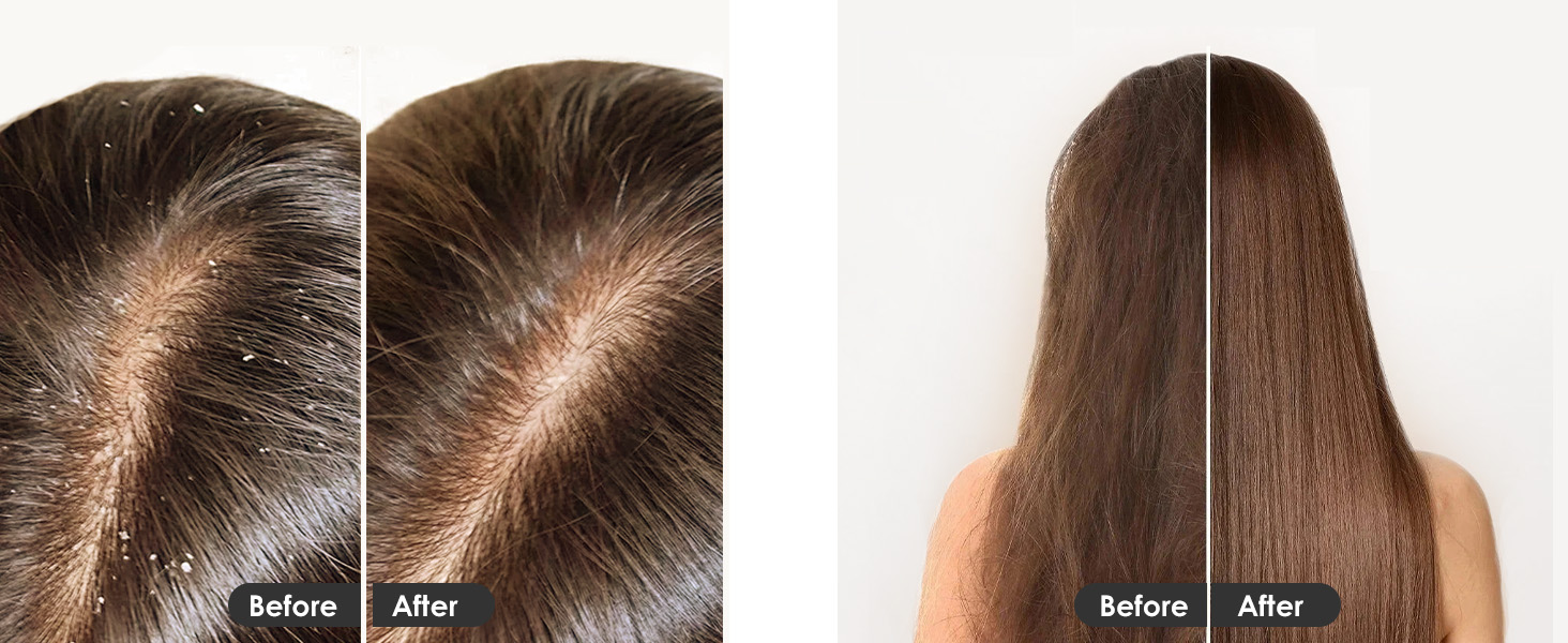 Scalp Exfoliator for Dandruff Removal