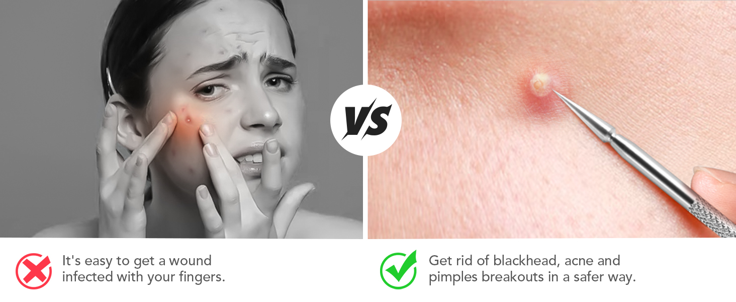 pimple popper tools