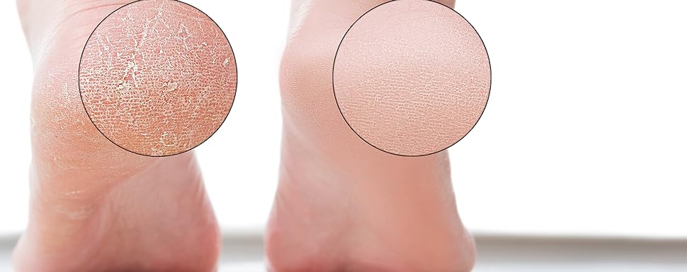 callus remover for feet