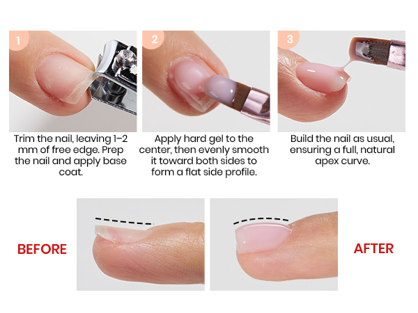 Correct Upward Curving Nails