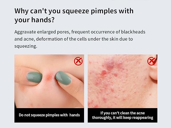 acne needles