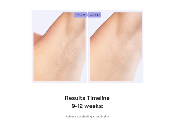 laser hair removal device