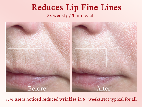 RF Skin Tightening Face Machine