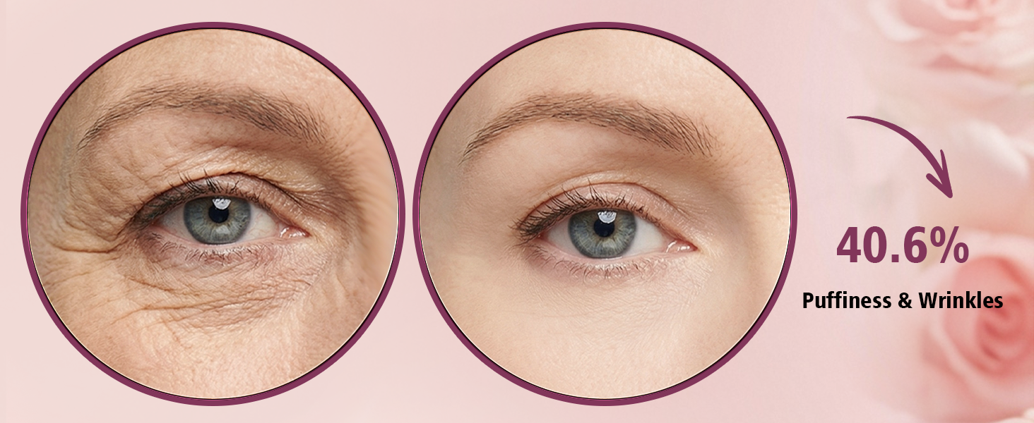 Puffiness &amp;amp; Wrinkles
