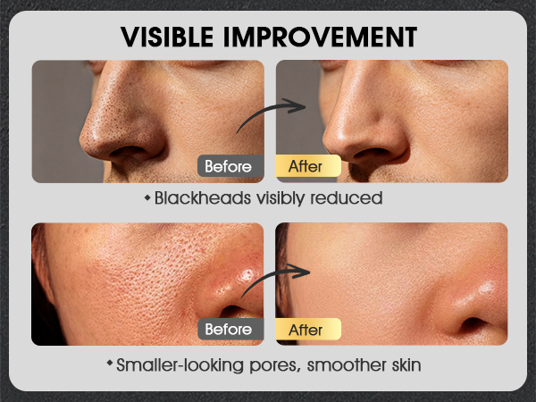 Blackhead Remover Mask Kit