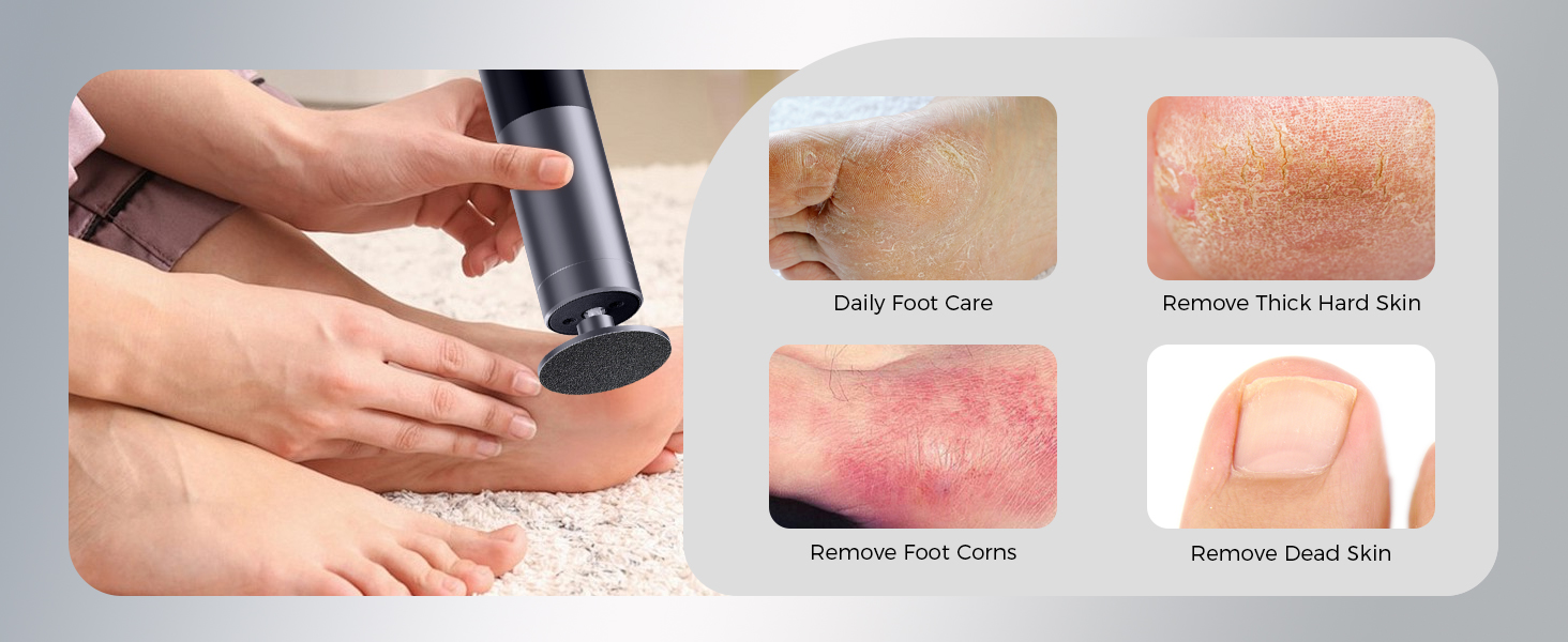 electric foot callus remover