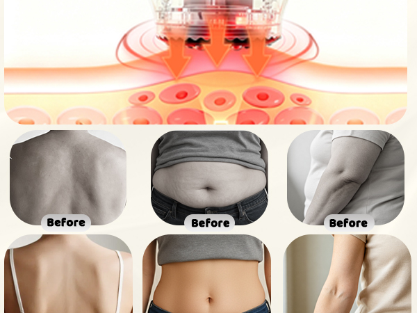 Lymphatic Drainage Massager