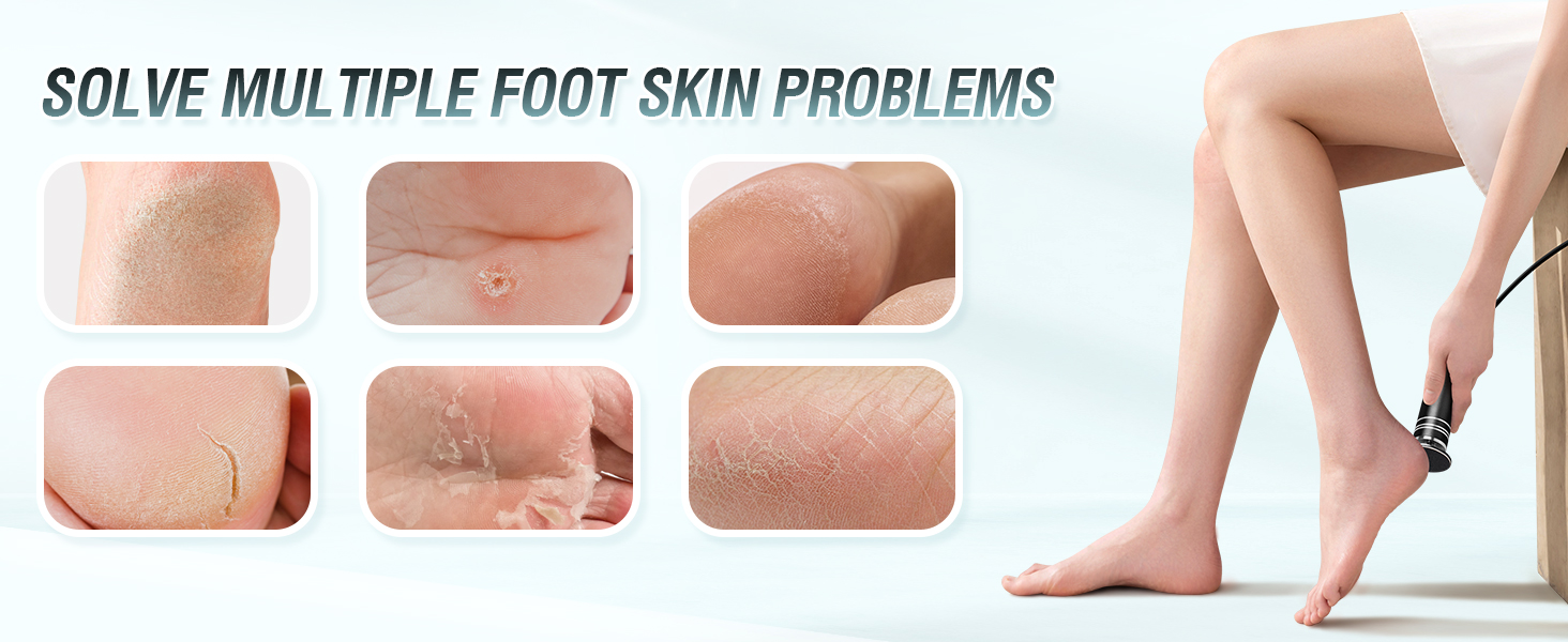 electric foot callus remover