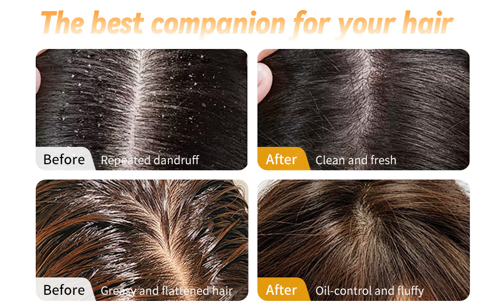 dandruff comb