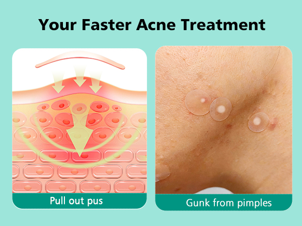 pimple patches
