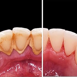 how to remove tartar from teeth