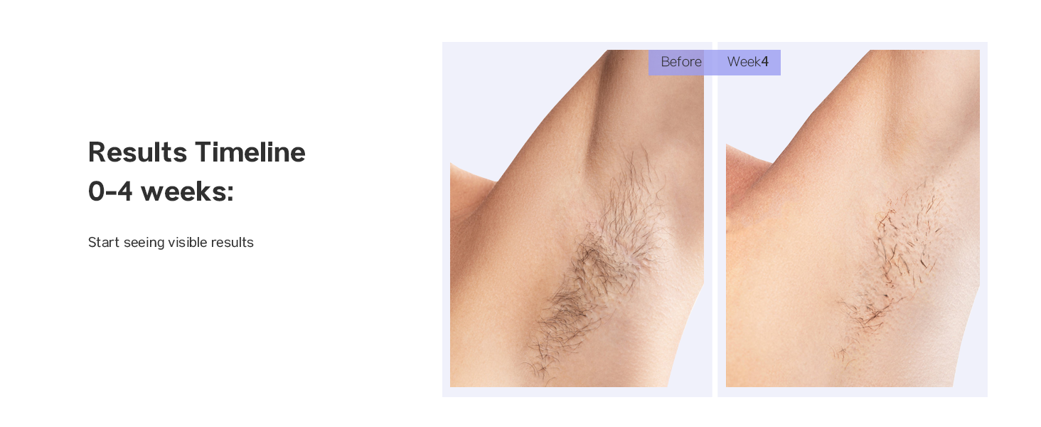 laser hair removal