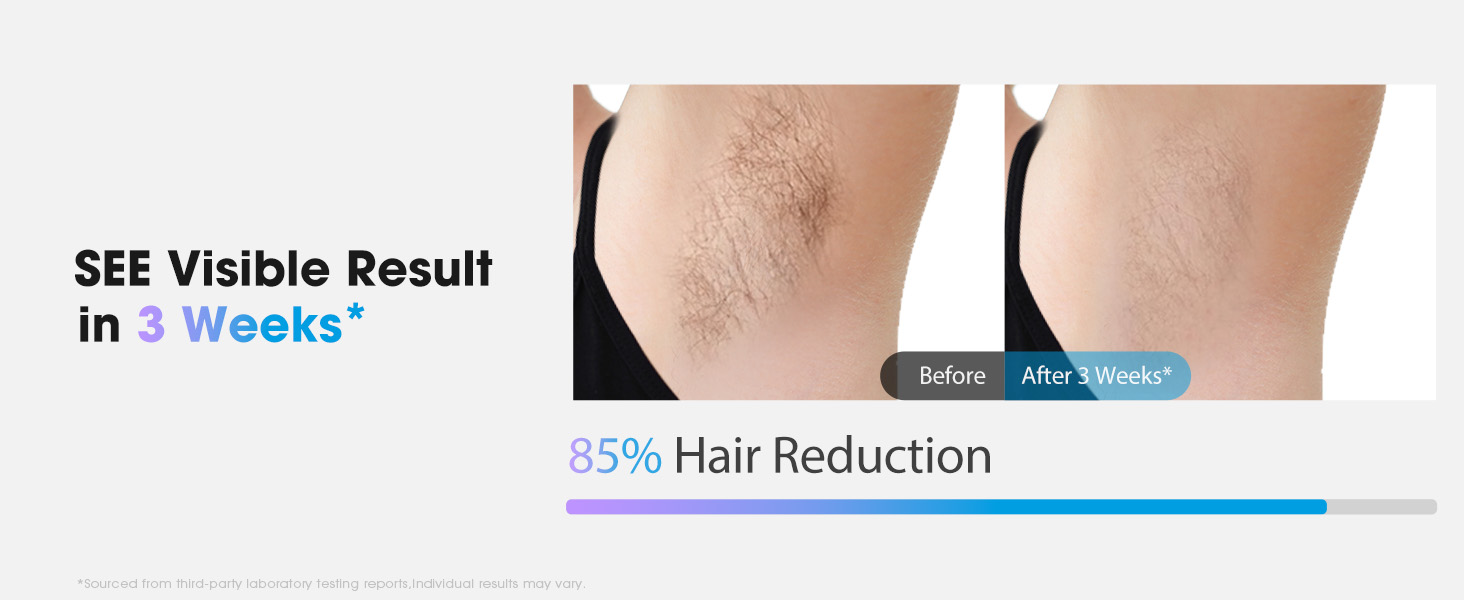 laser hair removal for women