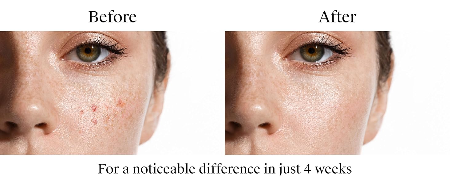 maximum strength 10% benzoyl peroxide acne prone skin care acne-fighting fsa has acne treatment