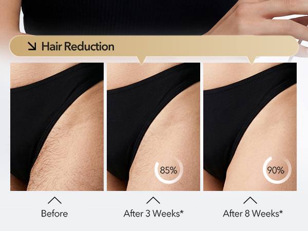 laser hair removal