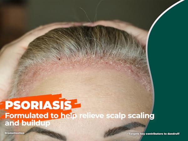 Psoriasis shampoo for scalp scaling and buildup, close-up of hairline with psoriasis flakes