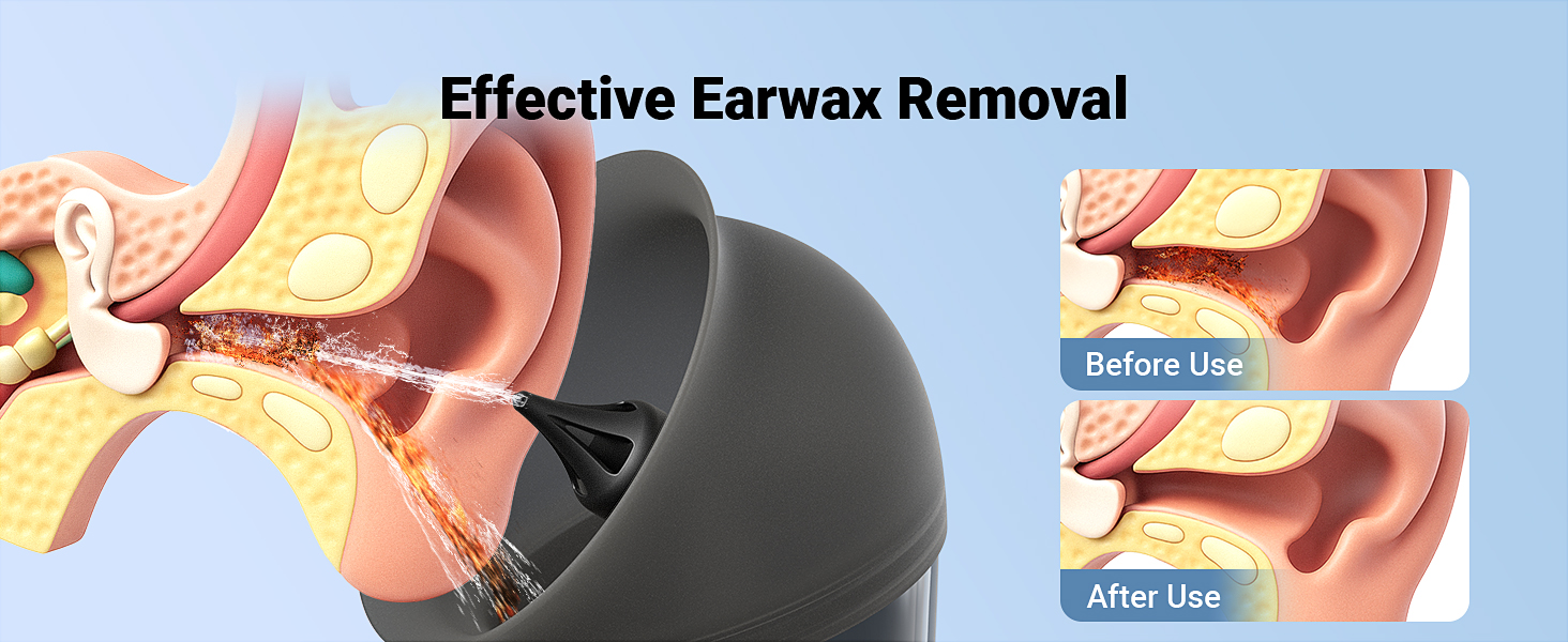 Earwax Removal