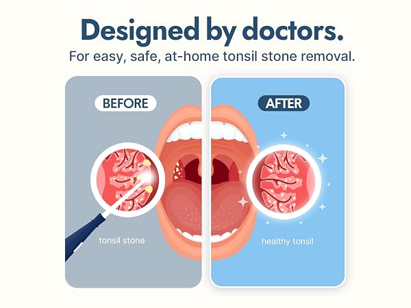 tonsil stone remover kit