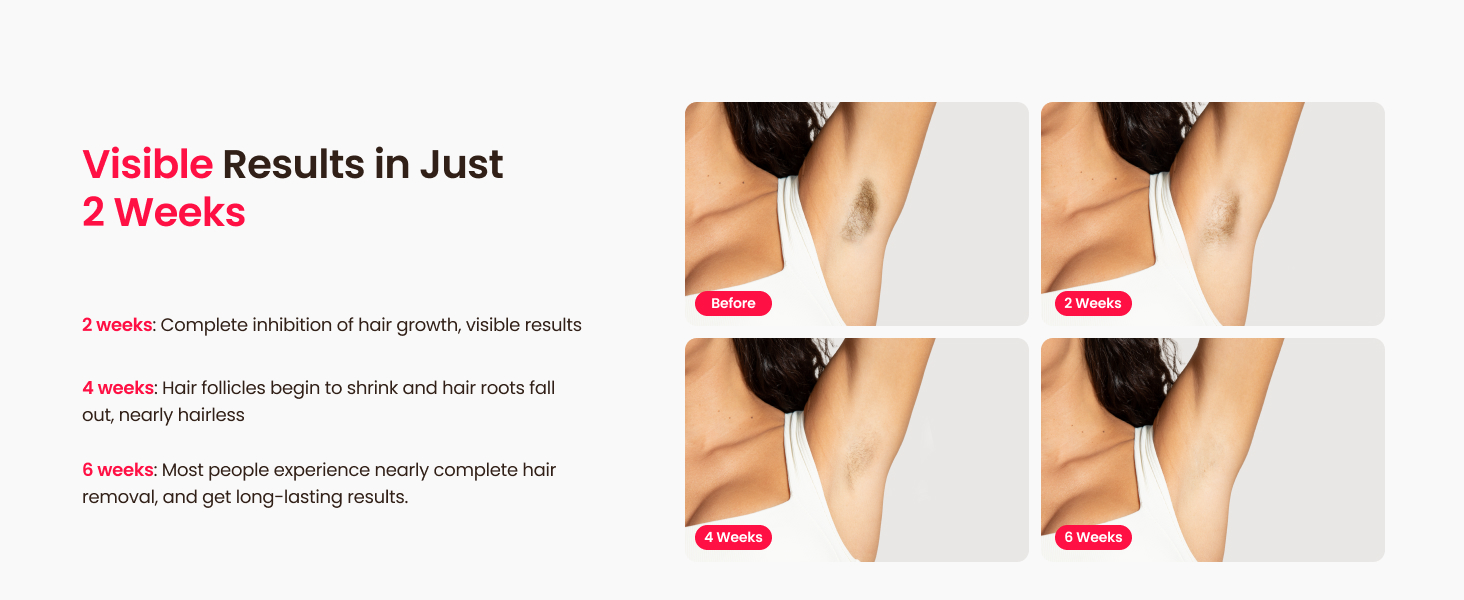 hair removal laser for women