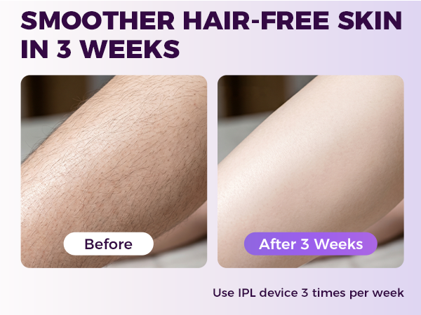 bikini hair removal device