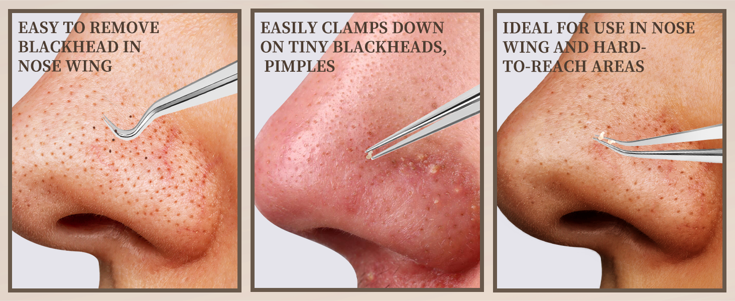 blackhead extractor tool