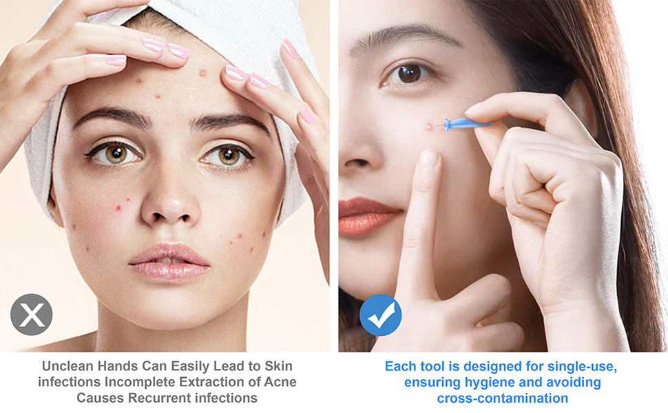 Acne Pimple Remover