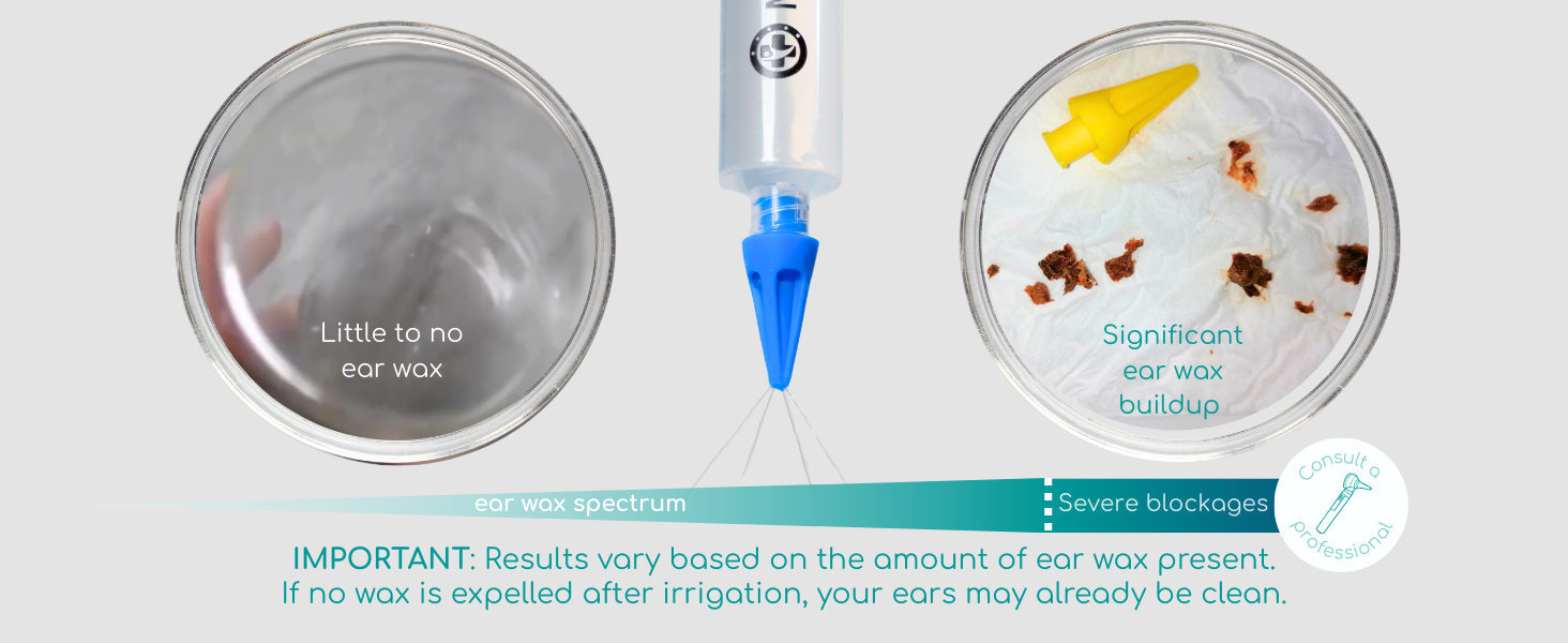 ear syringe with basins on both side showing no earwax and ear wax on the other basin
