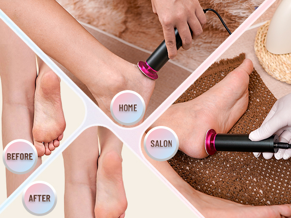 electric callus remover