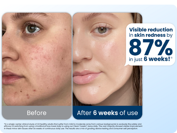 Visible reduction in skin redness by 87% in just 6 week