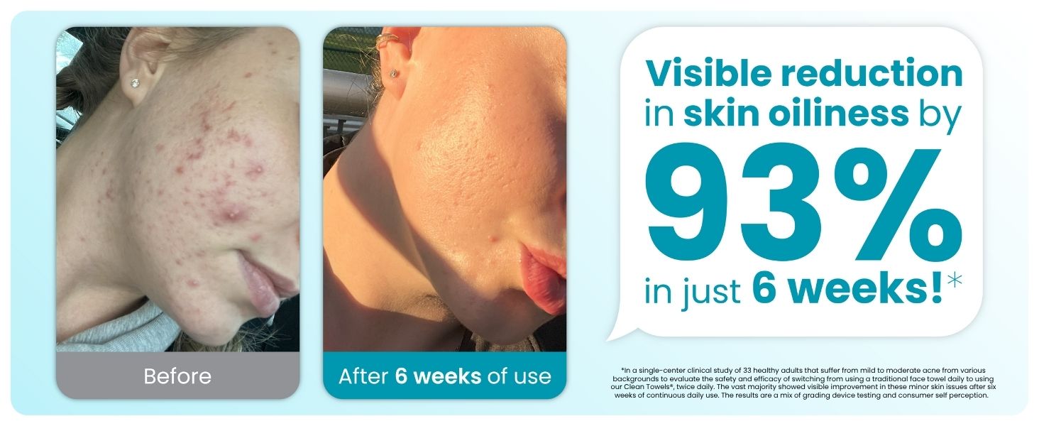 Visible Reduction in Skin Oiliness by 93% in just 6 weeks