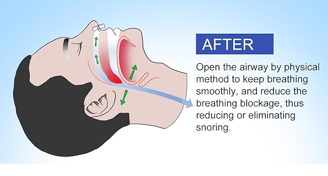 open the airway and reduce snoring