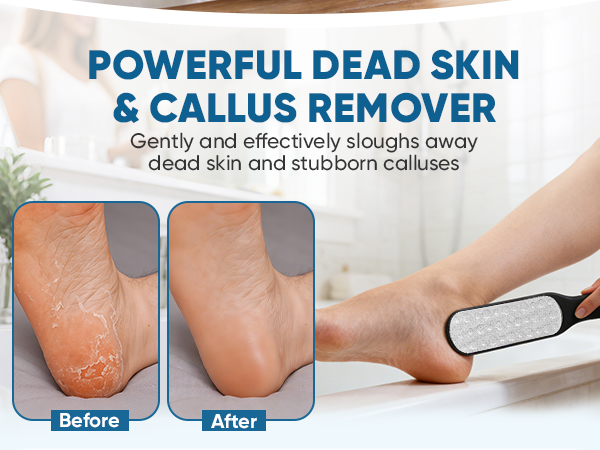 POWERFUL DEAD SKIN &amp; CALLUS REMOVER