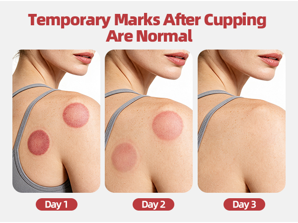 cupping set cupping therapy set cupping kit for massage therapy