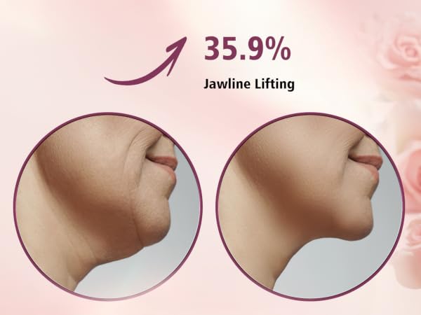 Jawline Lifting