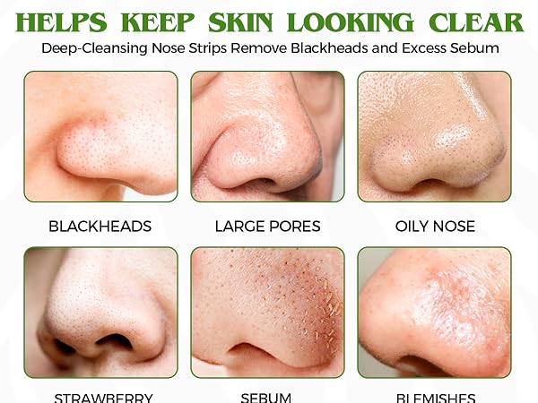 blackhead remover strips