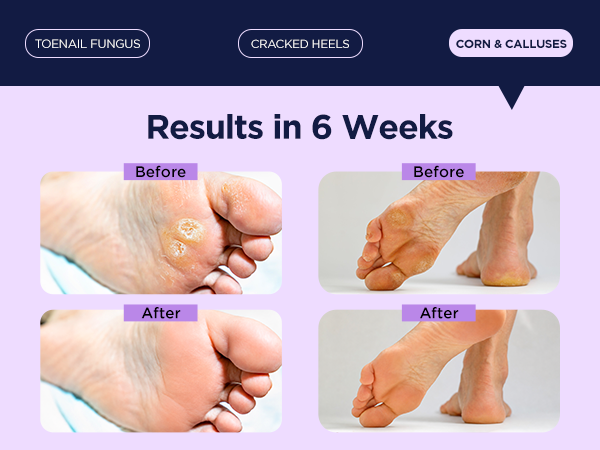 Corn and Calluses