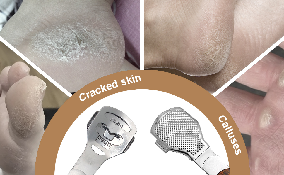 Callus Shaver