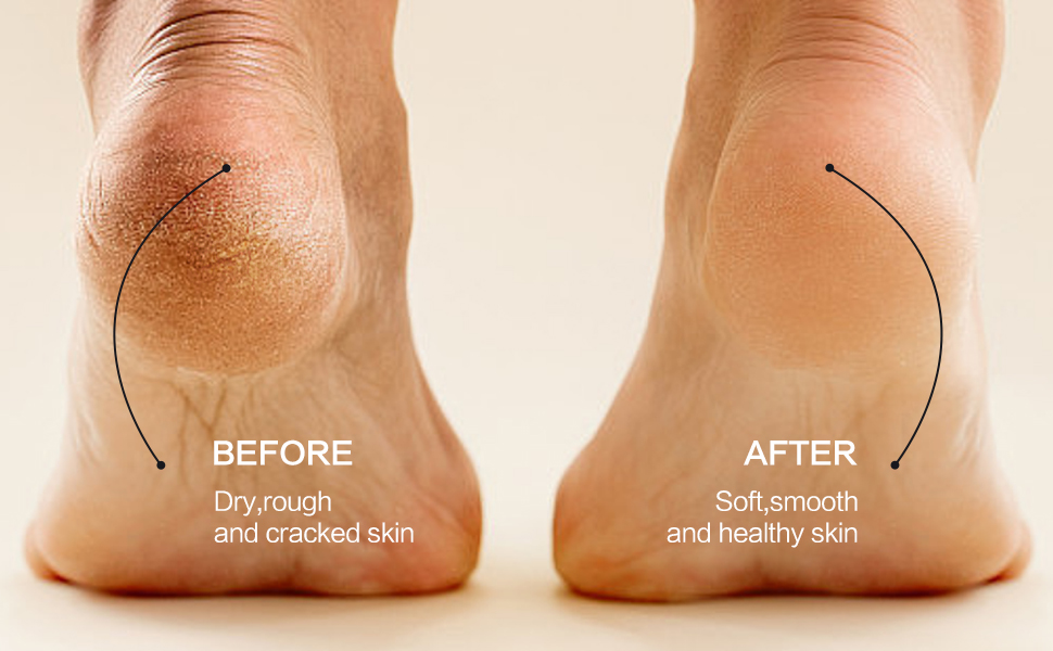 electric foot file