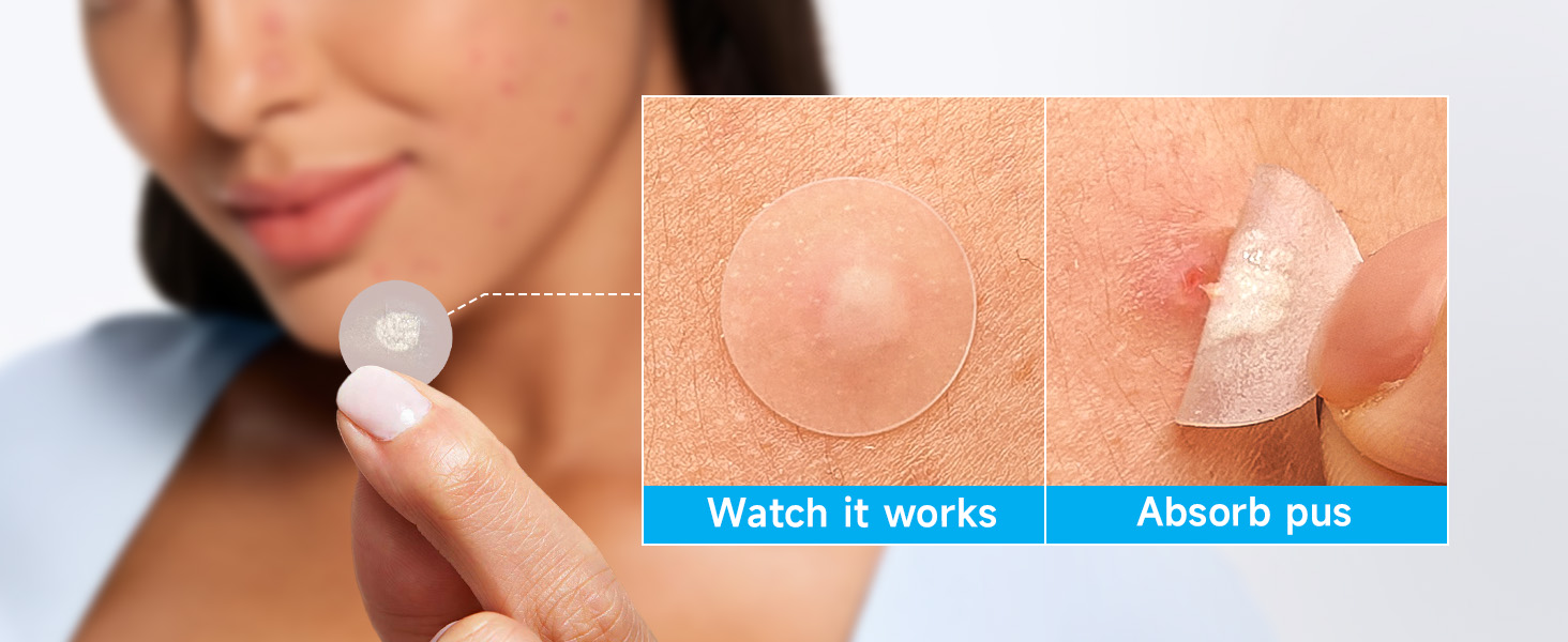 pimple patches