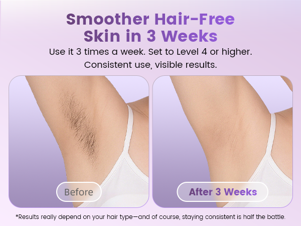 hair removal