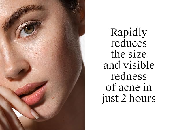 benzoyl peroxide face wash back acne treatment dark spot remover for face pimple cream acne patch