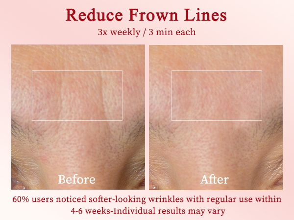 Radio Frequency Skin Tightening Device