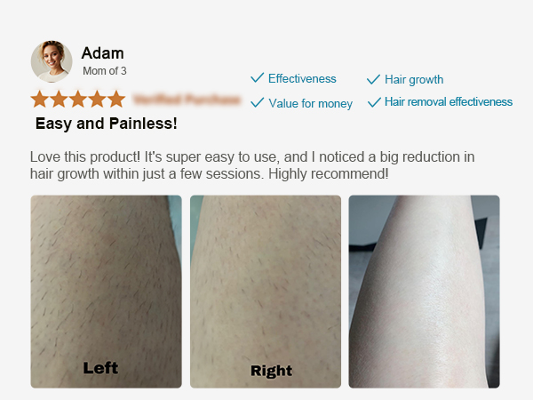 Laser Hair Removal
