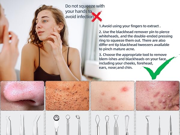 Acne Pimple Extractor Tool