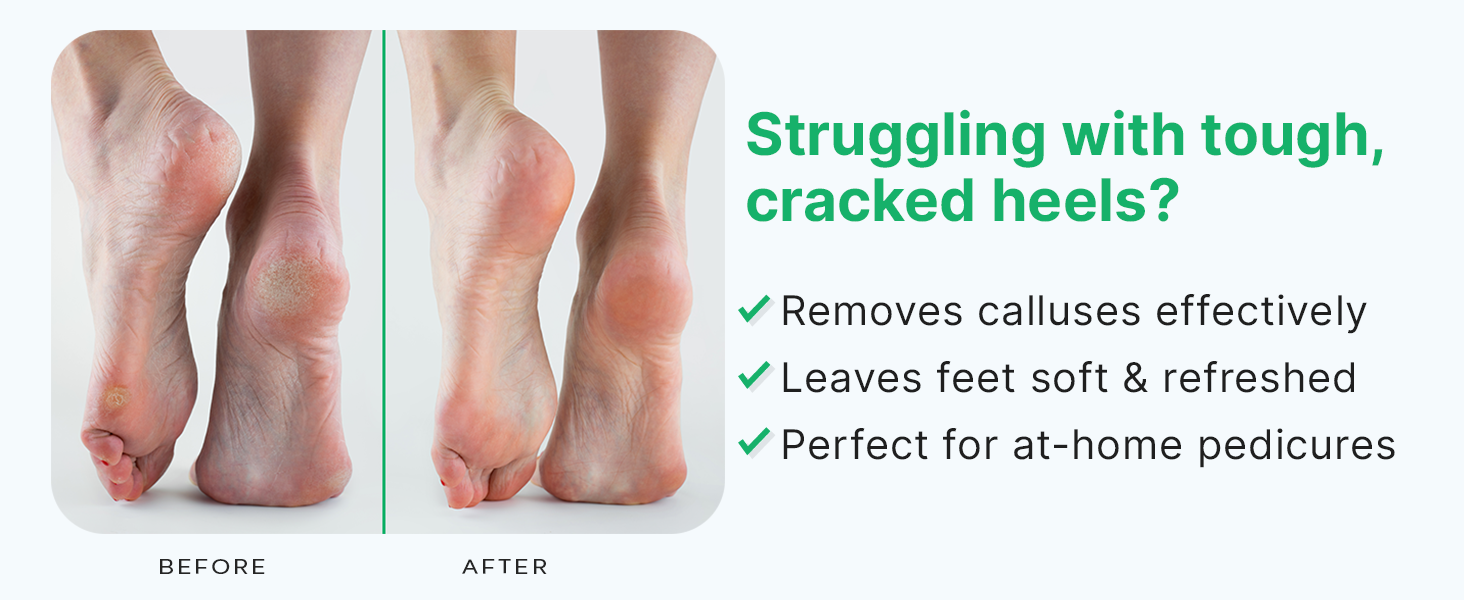 remover pedicure tool file dry callus foot beauty skin health care hard best surface wet remove
