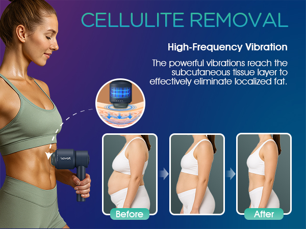 CELLULITE REMOVAL