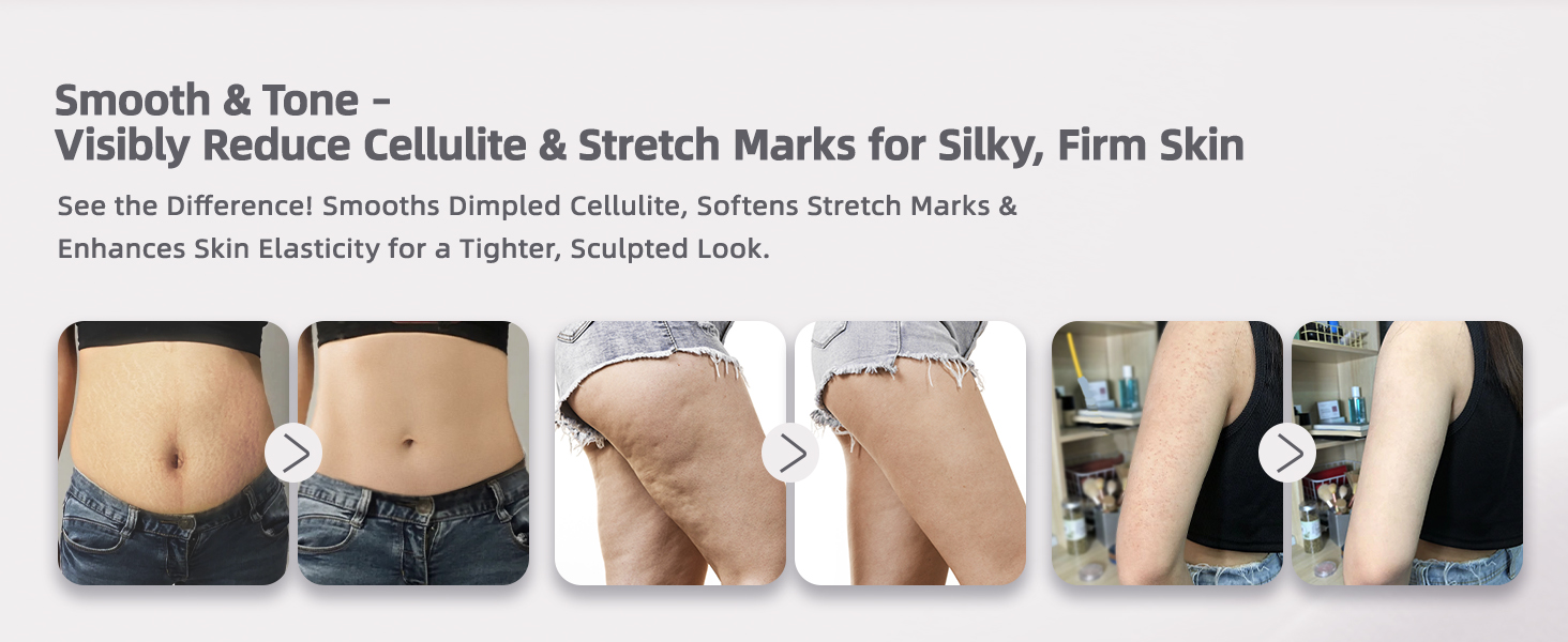 lymphatic drainage massager; stretch marks removal; body sculpting machine; cellulite massager