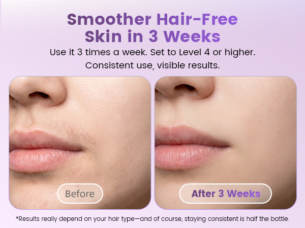 hair removal