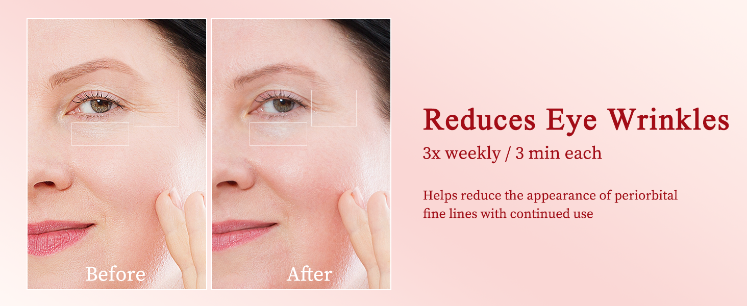 Skin Tightening Device